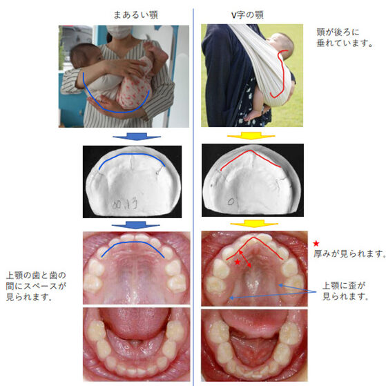 赤ちゃん歯科（抱っこ例）