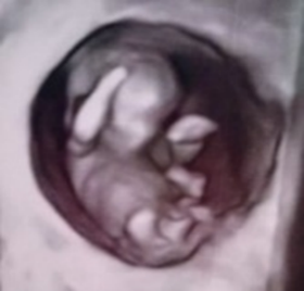 こどもの矯正とランパセラピー