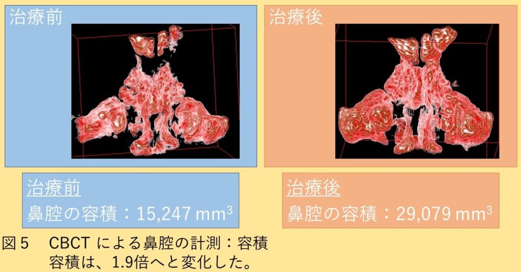 RAMPAによる鼻副鼻腔容積の変化