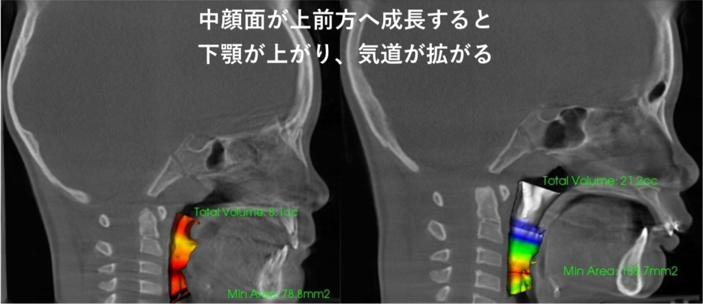 RAMPA前と治療中の気道容積の変化を示すレントゲン
