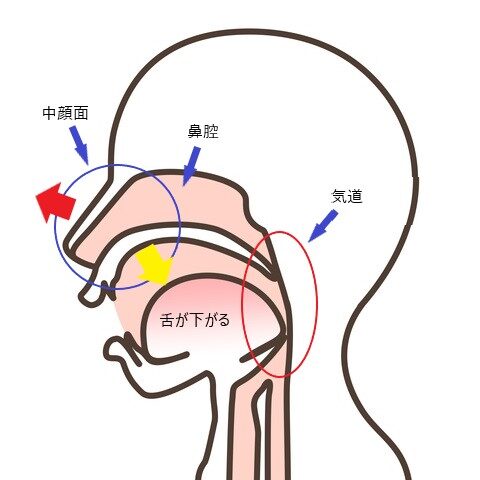 こどもの矯正とランパセラピー