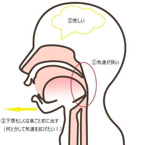こどもの矯正とランパセラピー