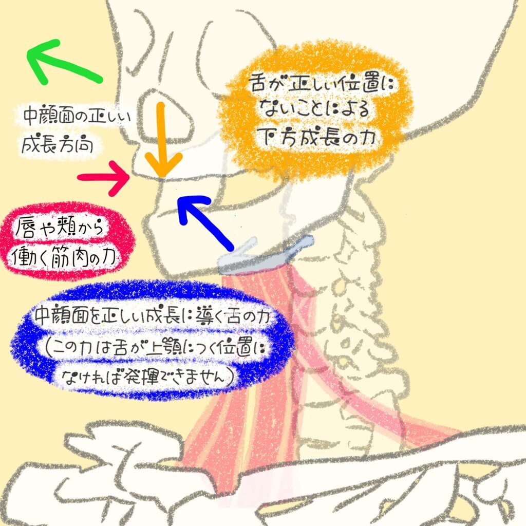 舌が上顎につかない（口呼吸）ことによる骨格への影響を示すイラスト