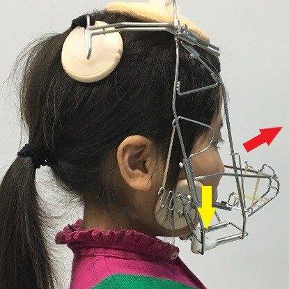 こどもの矯正とランパセラピー