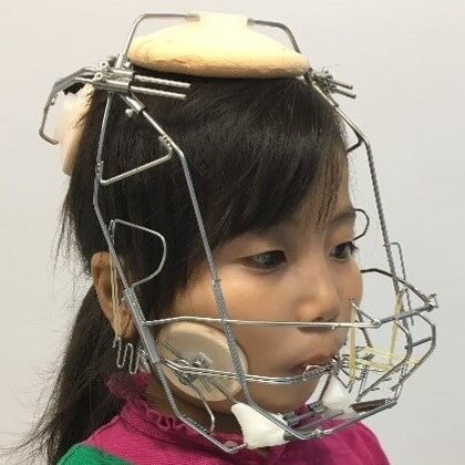 ランパセラピー（ランパ矯正）