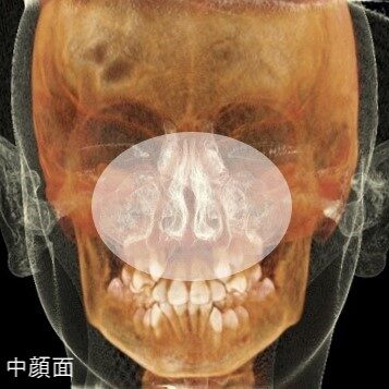 中顔面の位置（鼻周辺の顔の中心部分）を示すレントゲン