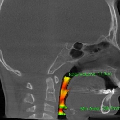 ランパセラピー（ランパ矯正）